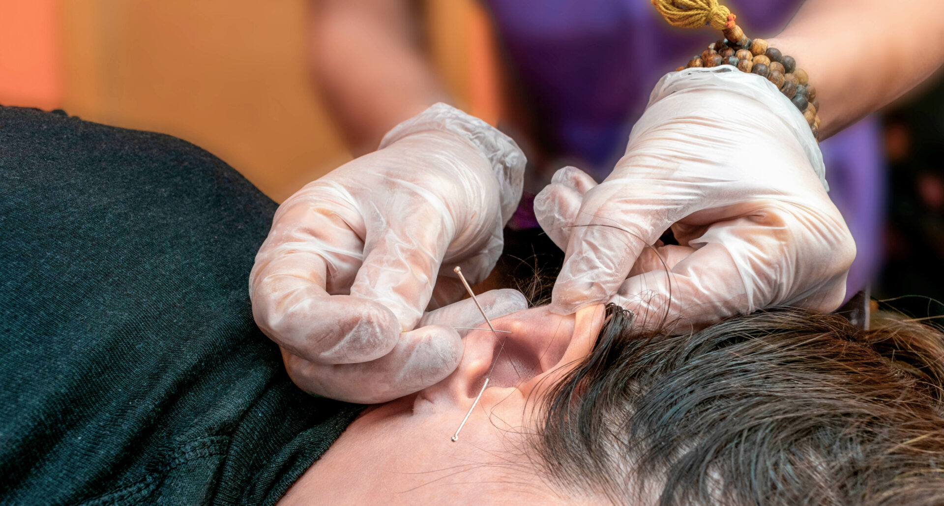 Auriculotherapy by using needles and pressure points